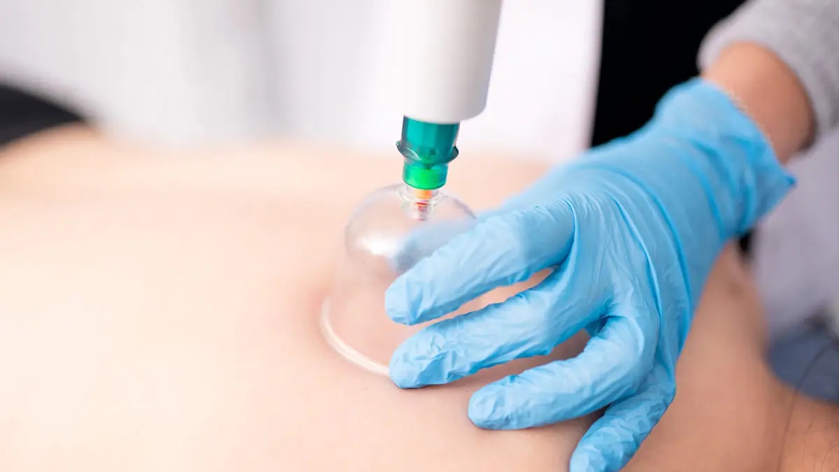 Profesyonel Hacamat Uygulaması - Koza Evde Sağlık